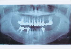 インプラント症例